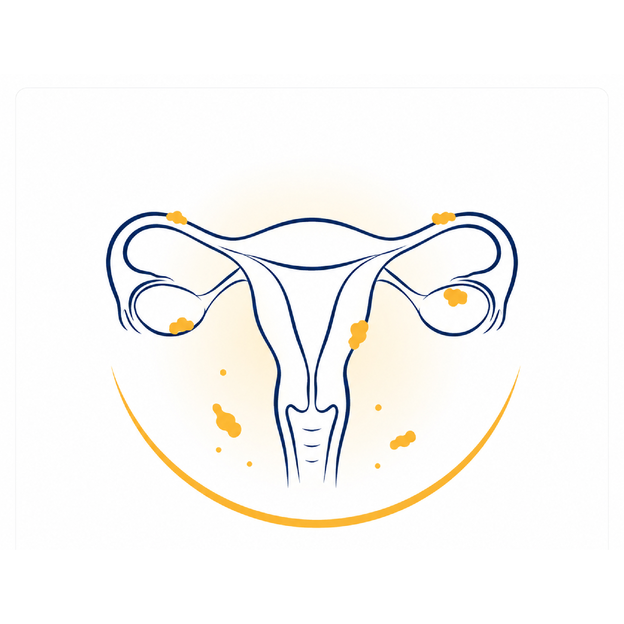 Endometriosis