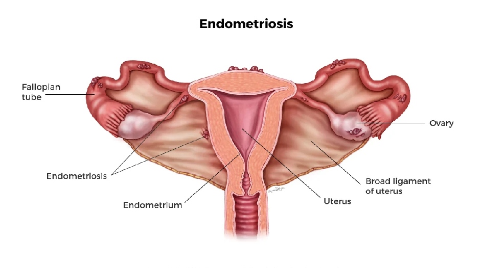 Endometriosis Specialist in Girgaon