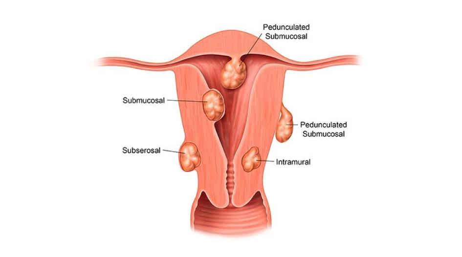 Fibroid Treatment Specialist