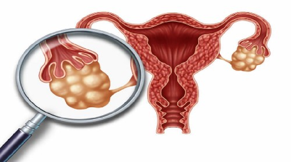 PCOS Specialist in Girgaon and Charni Road